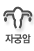 자궁암