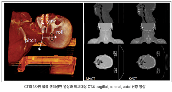 CT의 3차원 볼륨 렌더링한 영상과 비교대상 CT의 sagittal, coronal, axial 단층 영상