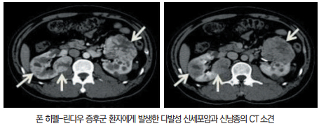 폰 히펠-린다우 증후군 환자에게 발생한 다발성 신세포암과 신낭종의 CT소견