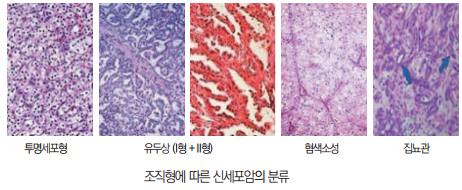 조직형에 따른 신세포암의 분류