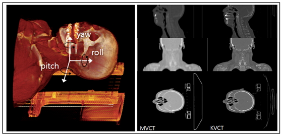 CT의 3차원 볼륨 렌더링한 영상과 비교대상 CT의 sagittal, coronal, axial 단층 영상
											