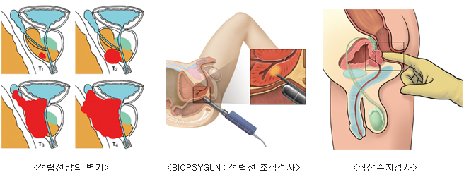 전립선 암의 병기, BIOPSYGUN:전립선 조직검사, 직장수지검사 사진