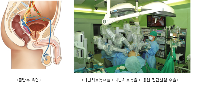 골반 부 측면, 다빈치로봇수술 : 다빈치로봇을 이용한 전립선암 수술 사진