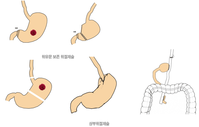 위유문 보존 위절제술, 상부위절제술 수술 사진