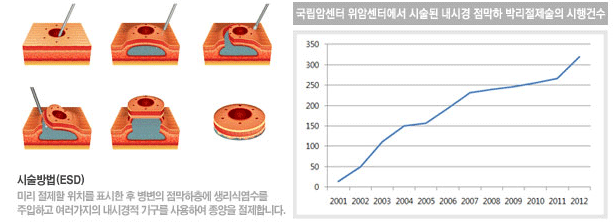 시술방법(ESD) 미리 절제할 위치를 표시한 후 병변의 점막하층에 생리식염수를 주입하고 여러가지의 내시경적 기구를 사용하여 종양을 절제합니다. 국립암센터 위암센터에서 시술된 내시경 점막하 박리절제술의 시행건수 그래프