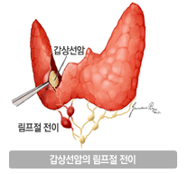 갑상선암의 림프절 전이