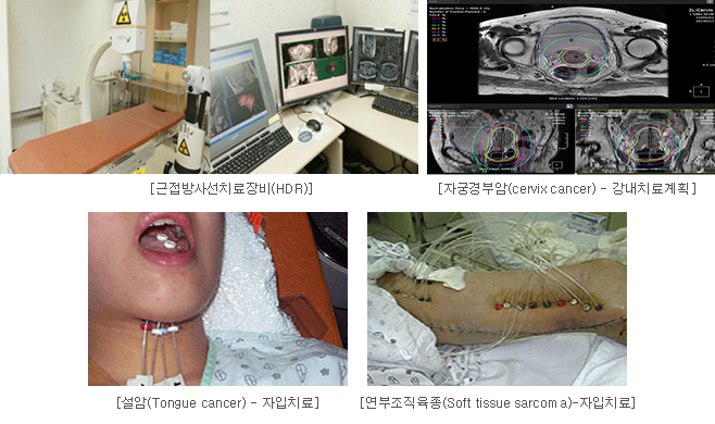 근접방사선치료장비(HDR)사진, 자궁경부암(cervix cancer)-강내치료 사진, 설암(Tongue cancer-자입치료 사진, 연부조직육종(Soft tissue sarcoma-자입치료)사진