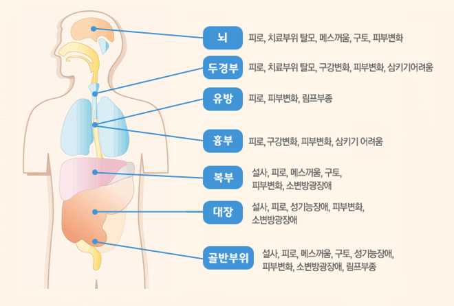 뇌 : 피로, 치료부위 탈모, 메스꺼움, 구토, 피부변화/두경부 : 피로, 치료부위 탈모, 구강변화, 피부변화, 삼키기어려움/유방 : 피로, 피부변화, 림프부종/흉부 : 피로, 구강변화, 피부변화, 삼키기 어려움/복부 : 설사, 피로, 메스꺼움, 구토, 피부변화, 소변방광장애/대장 : 설사, 피로, 성기능장애, 피부변화, 소변방광장애/골반부위 : 설사, 피로, 메스꺼움, 구토, 성기능장애, 피부변화, 소변방광장애, 림부종