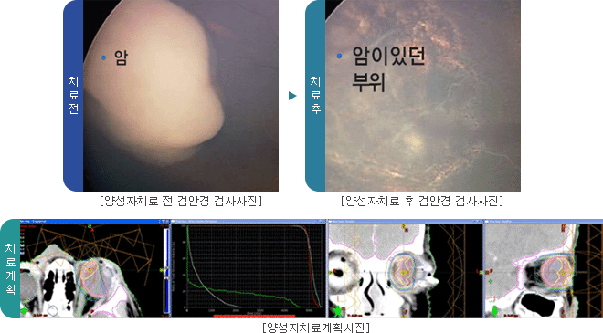 양성자치료 전 검안경 검사사진, 양성자치료 후 검안경 검사사진, 양성자치료 계획사진