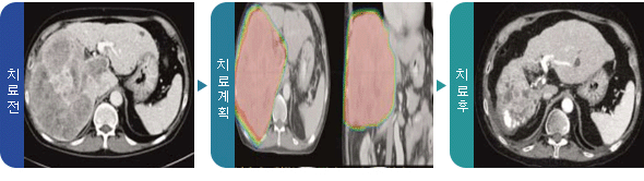 간세포암 치료 전, 양성자 치료계획, 치료 후 사진