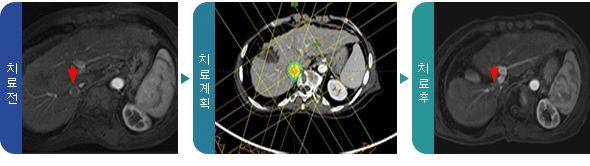 치료 전, 양성자 치료계획, 치료 후 사진
