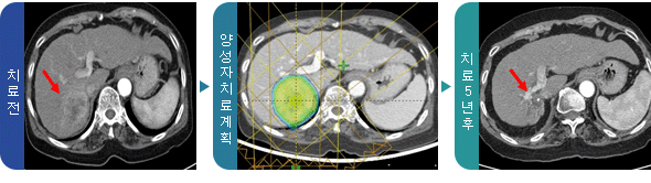 수술이 어려운 간암 치료 전, 양성자 치료계획, 치료 5년후 사진