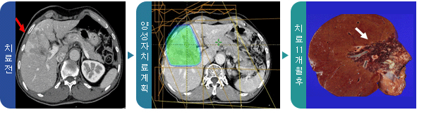 치료 전, 양성자 치료계획, 양성자치료 11개월 후+항암치료→우측 간절제술(완전관해) 사진