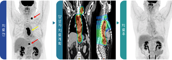 식도암 치료전, 양성자 치료계획, 치료후 사진