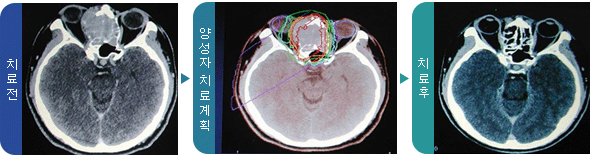 치료전, 양성자 치료계획, 치료후 사진