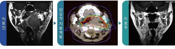 치료전, 양성자 치료계획, 치료후 사진